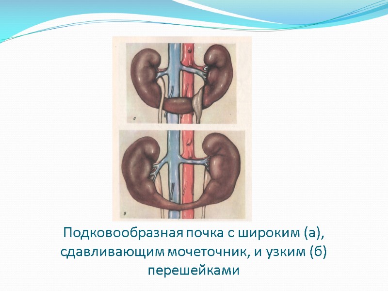 Подковообразная почка с широким (а), сдавливающим мочеточник, и узким (б) перешейками